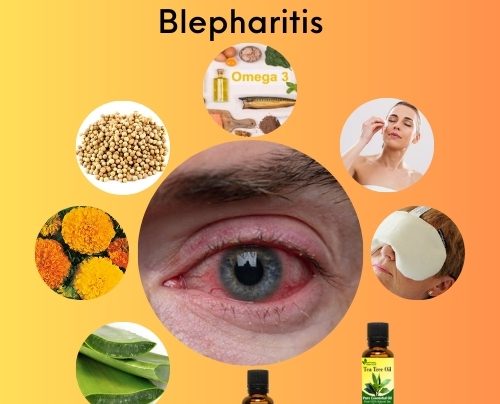 10 Natural Treatment for Blepharitis