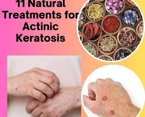 11 Natural Treatments for Actinic Keratosis