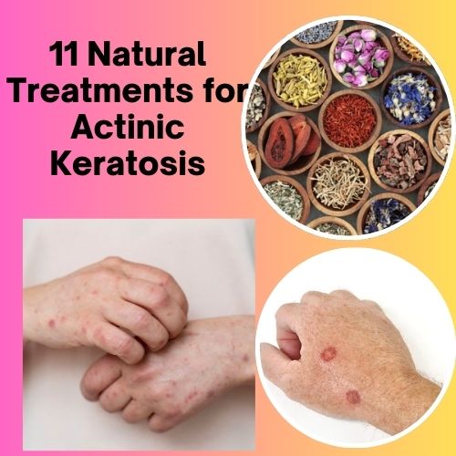 11 Natural Treatments for Actinic Keratosis