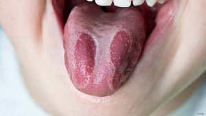 Burning Mouth Syndrome