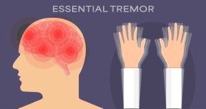 Essential Tremor Holistic Treatment