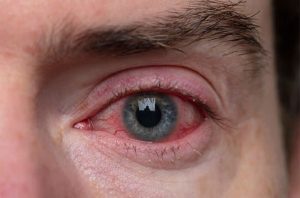 Herbal Treatment for Blepharitis