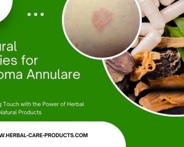 10 Natural Remedies for Granuloma Annulare