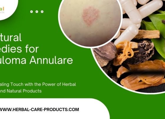 10 Natural Remedies for Granuloma Annulare