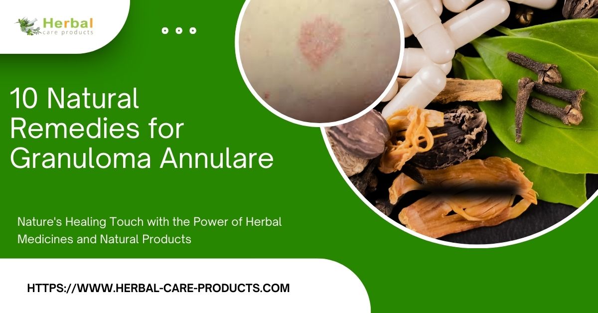 10 Natural Remedies for Granuloma Annulare