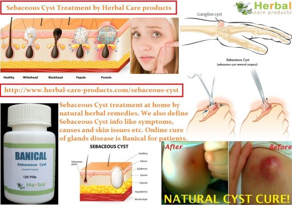10 Natural Remedies for Sebaceous Cyst