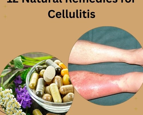 12 Natural Remedies for Cellulitis