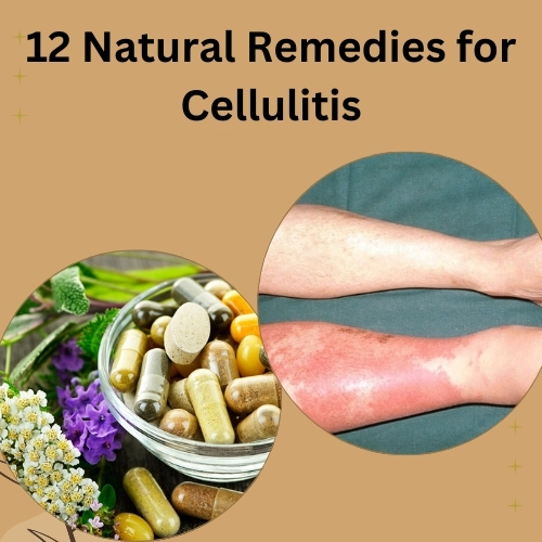 12 Natural Remedies for Cellulitis