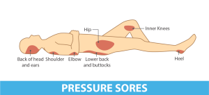 Applying pressure on the affected area