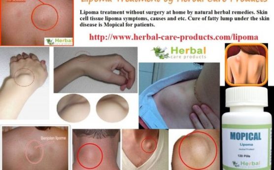 Best Lipoma Removal Supplement and Remedies