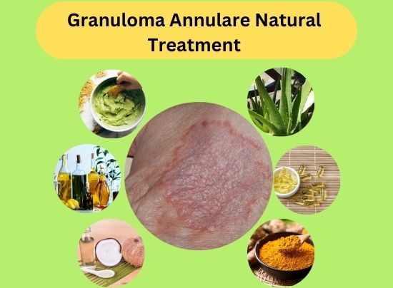 Granuloma Annulare Natural Treatment (2)