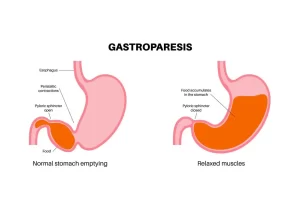 Home Remedies for Gastroparesis