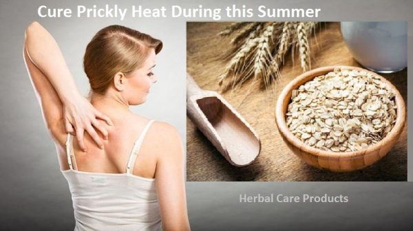 How to Cure Prickly Heat Rash During this Summer