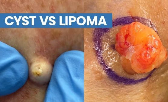 Lipoma vs Sebaceous Cyst Definition, Causes, and Symptoms