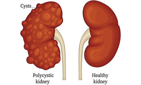 Most 12 Deadly Symptoms Of Kidney Diseases You Shouldnt Ignore