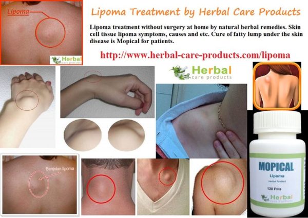 Natural Herbal Treatment for Lipoma and Symptoms, Causes