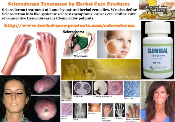 Natural Herbal Treatment for Scleroderma and Symptoms, Causes