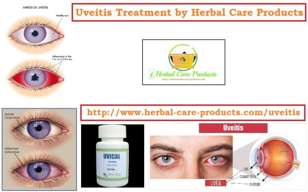 Natural Herbal Treatment for Uveitis Symptoms and Causes