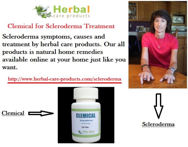 Scleroderma Treatment