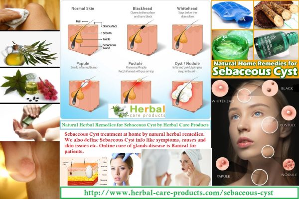 Sebaceous Cyst Natural Herbal Remedies for Skin Glands