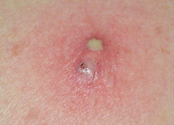 The Basics of Infected Sebaceous Cyst Removal