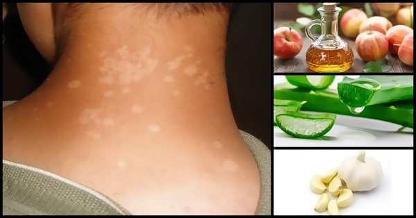 Tinea Versicolor Home Remedies and Natural Treatment