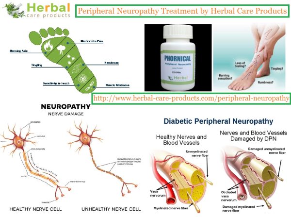 Treatment for Peripheral Neuropathy by Natural Herbal Remedies