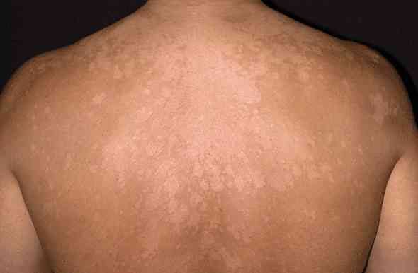 What Is Tinea Versicolor Treatment