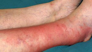 What is Cellulitis