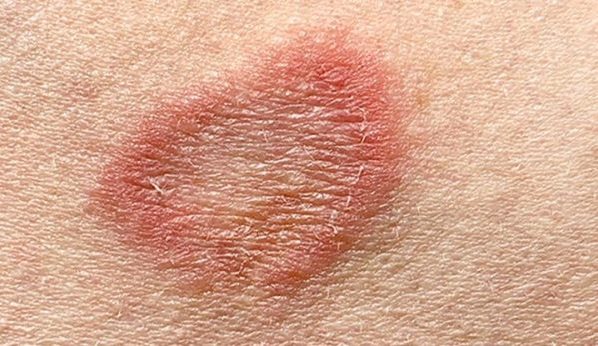 ringworm-type-appearances-of-bumps-symptoms-and-its-treatment