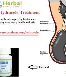 10 Natural Remedies for Hydrocele