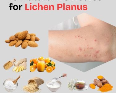 10 Natural Remedies for Lichen Planus (2)