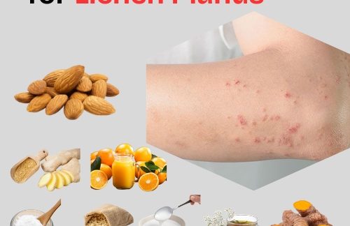 10 Natural Remedies for Lichen Planus (2)