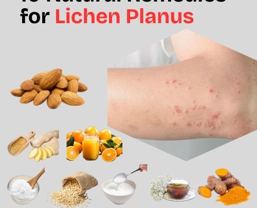 10 Natural Remedies for Lichen Planus (2)