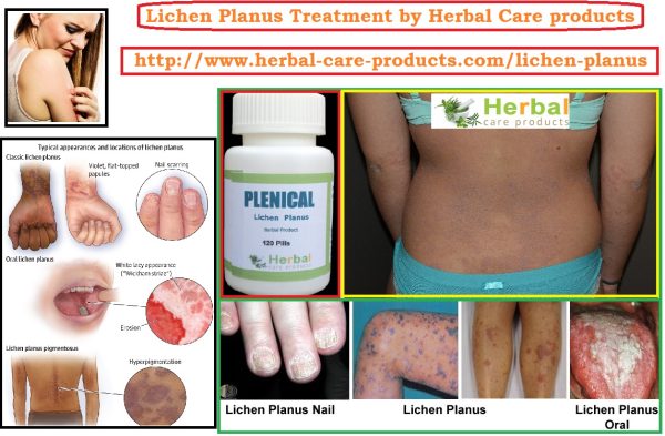 10 Natural Remedies for Lichen Planus