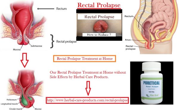 10 Natural Remedies for Rectal Prolapse