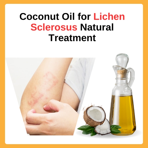 Coconut Oil for Lichen Sclerosus Natural Treatment