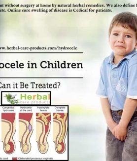 Hydrocele Natural Herbal Remedies for Pain