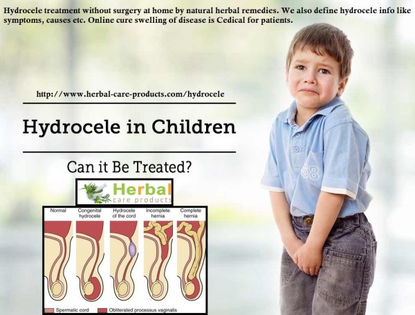 Hydrocele Natural Herbal Remedies for Pain