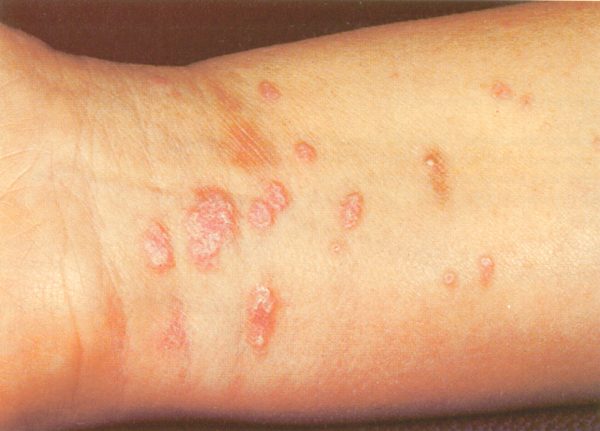 Lichen Planus – Annular Pattern Disease – Skin Disorder