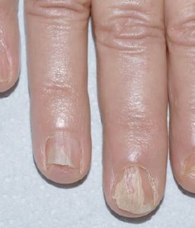 Mastering Lichen Planus Nails Treatment