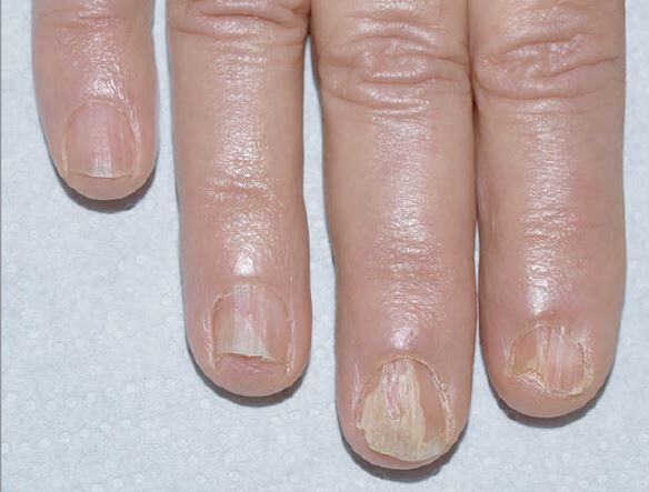 Mastering Lichen Planus Nails Treatment: A Definitive Guide
