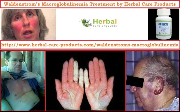 Natural Herbal Treatment for Waldenstrom’s Macroglobulinemia and Symptoms, Causes