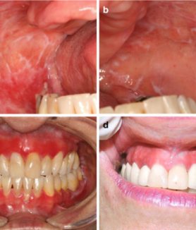 Oral Lichen Planus vs Leukoplakia