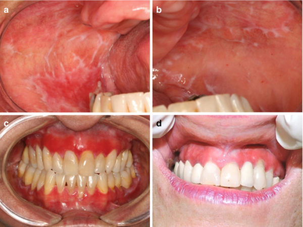 Oral Lichen Planus vs Leukoplakia: A Detailed Comparison