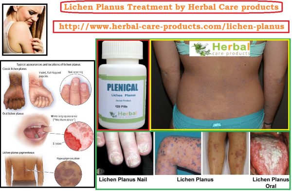 Treatment for Lichen Planus by Natural Herbal Remedies