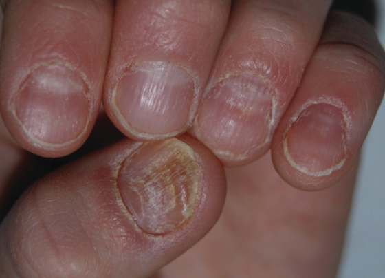 What Causes Lichen Planus Nails and How to Manage It