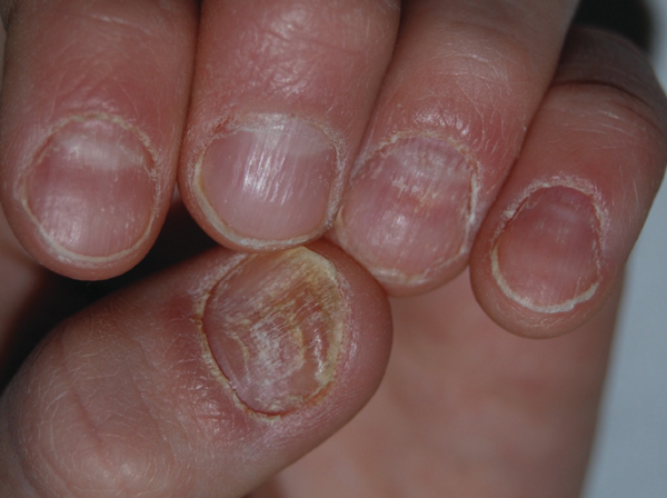 What Causes Lichen Planus Nails and How to Manage It?