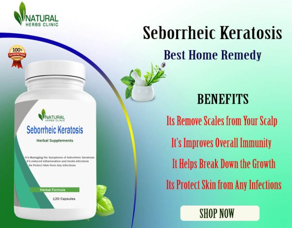 Affected with Seborrheic Keratosis Read about Home Remedies Benefits