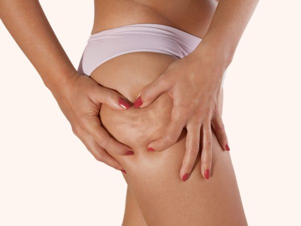 Most 16 Natural Home Remedies for Cellulite